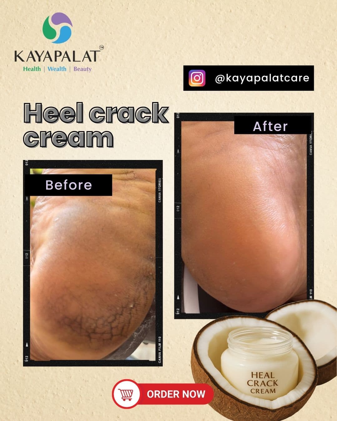 Heel Crack Cream | Ayurvedic Heel Repair Cream | Softer Heels| Repair Dry, Hard & Cracked Heels